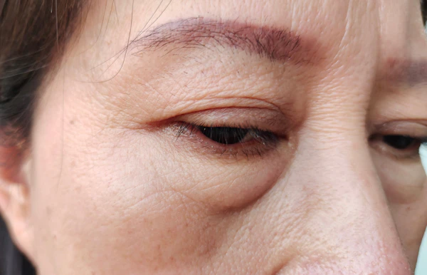 woman with under eye bags