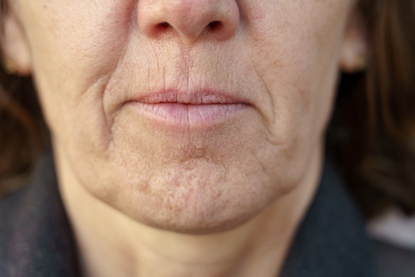 woman with lines around her mouth