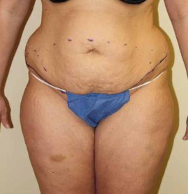 Tummy tuck before photo