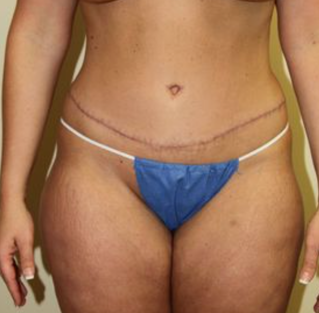 Tummy tuck after photo