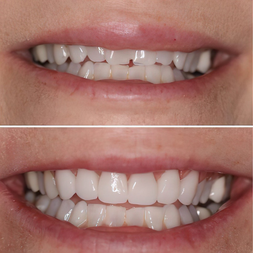 Veneers Cost Nashville, TN How Much Are Veneers Iroquois Dentistry