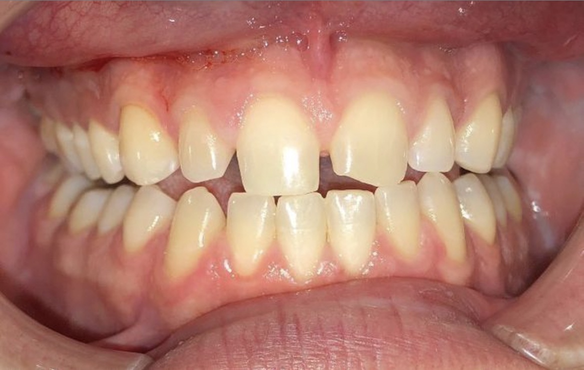 Case #8 before veneers procedure