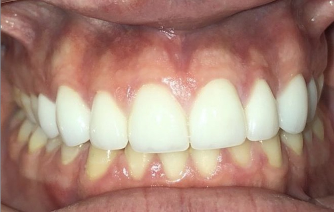Case #8 after veneers procedure