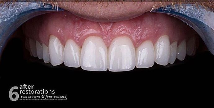 After porcelain Veneers and crowns