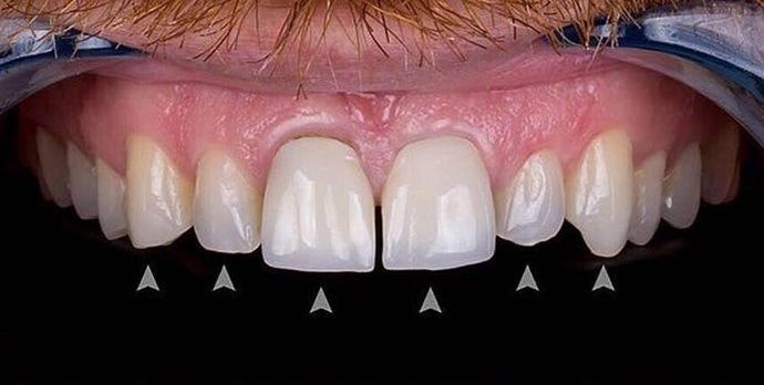 Before porcelain veneers and crowns