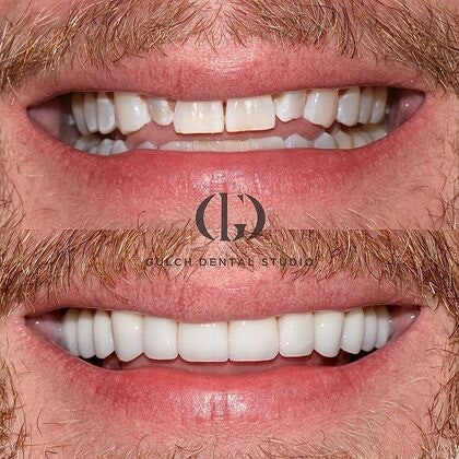 Real patient before and after veneers