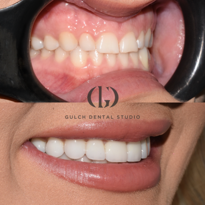Real patient before and after veneers