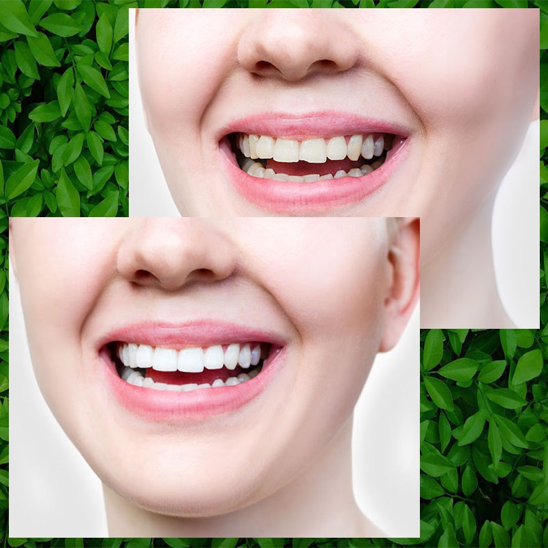 Before and after teeth whitening