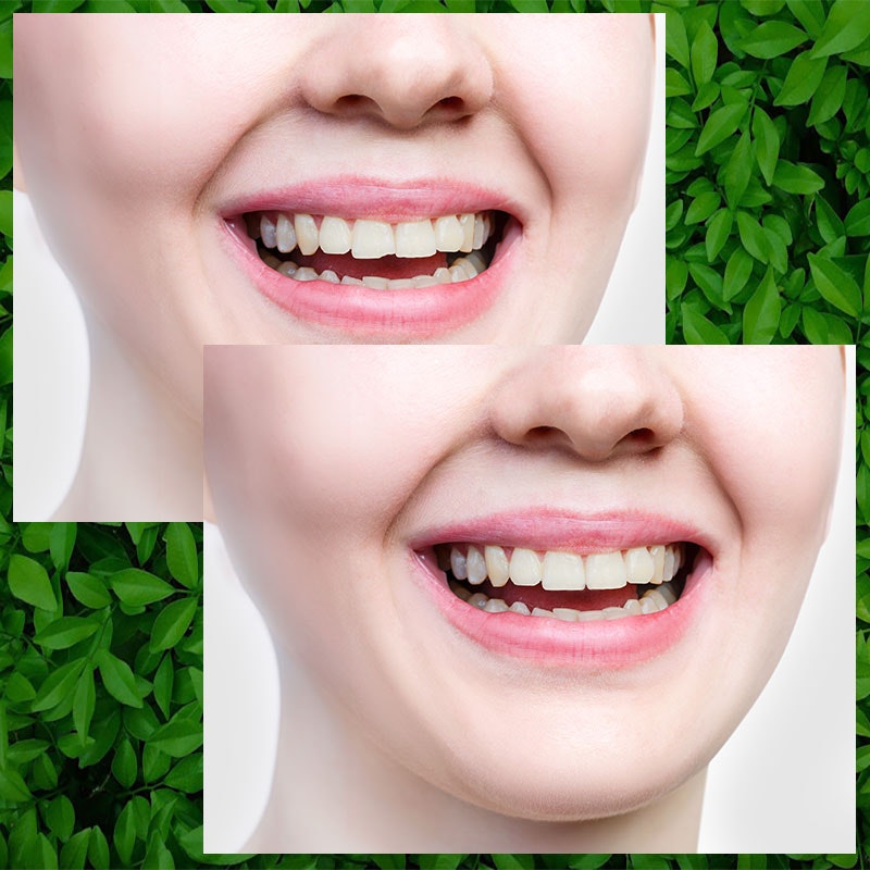 Before and after dental bonding