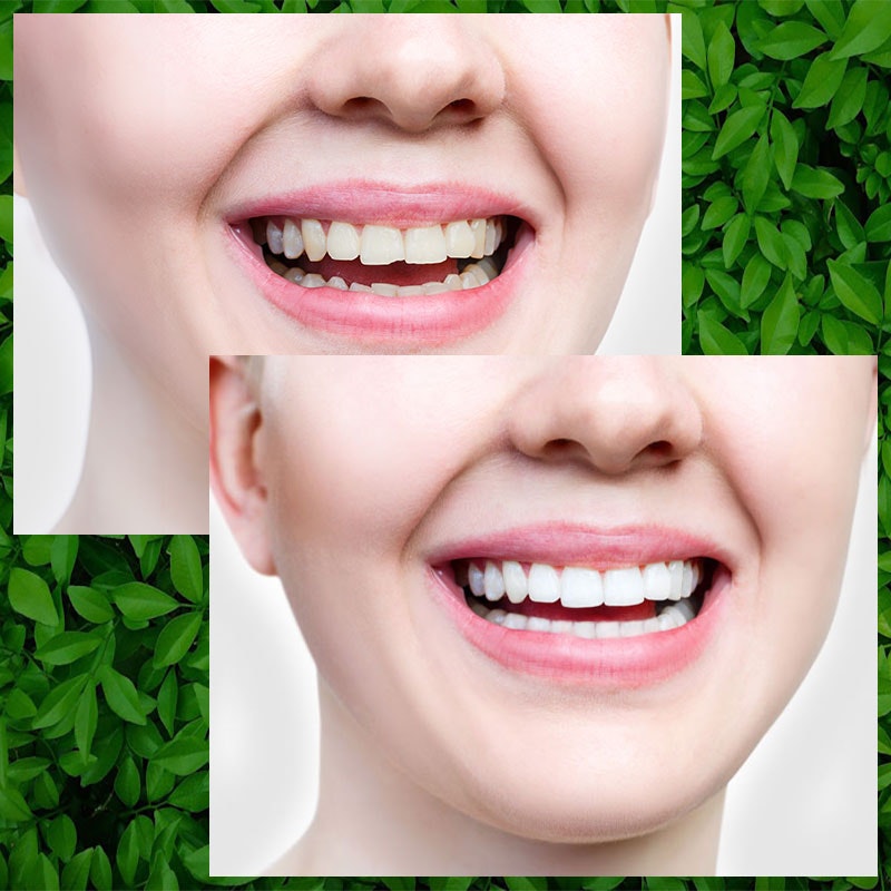 Before and after Invisalign