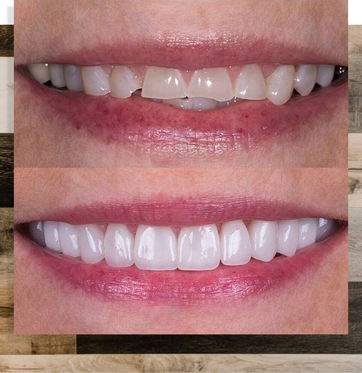 Before and after crowns