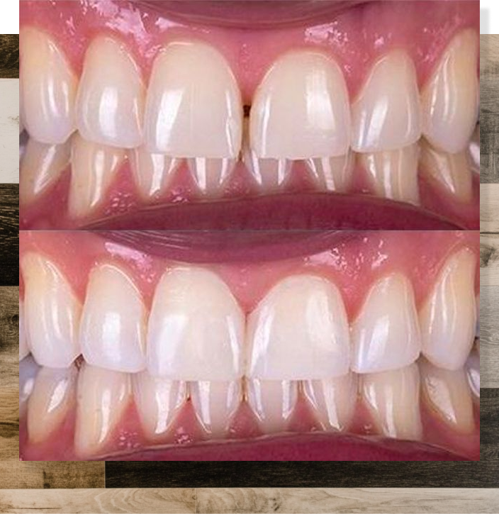 Before and after bonding