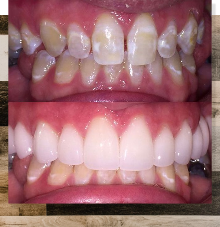 Before and after veneers