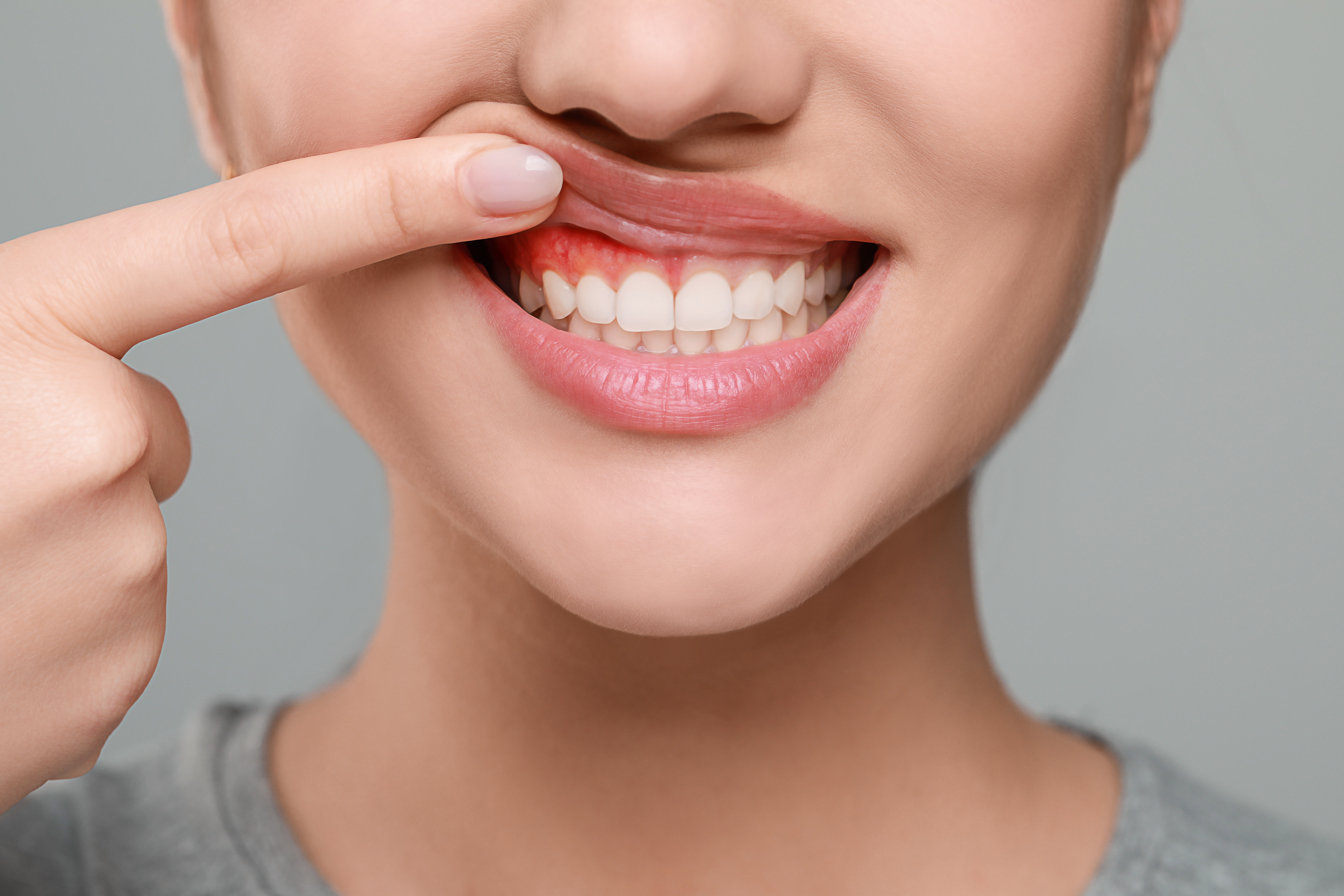 woman lifting lip to show gum irritation