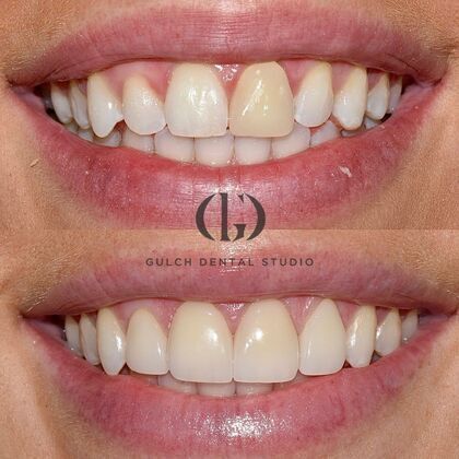 Gulch Dental Studio smile makeover patient before and after