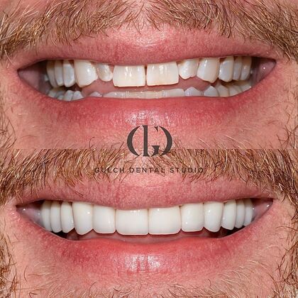 smile makeover before and after