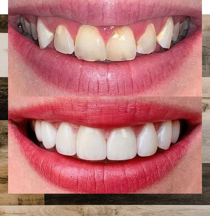 Veneers before and after