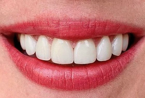 After veneers