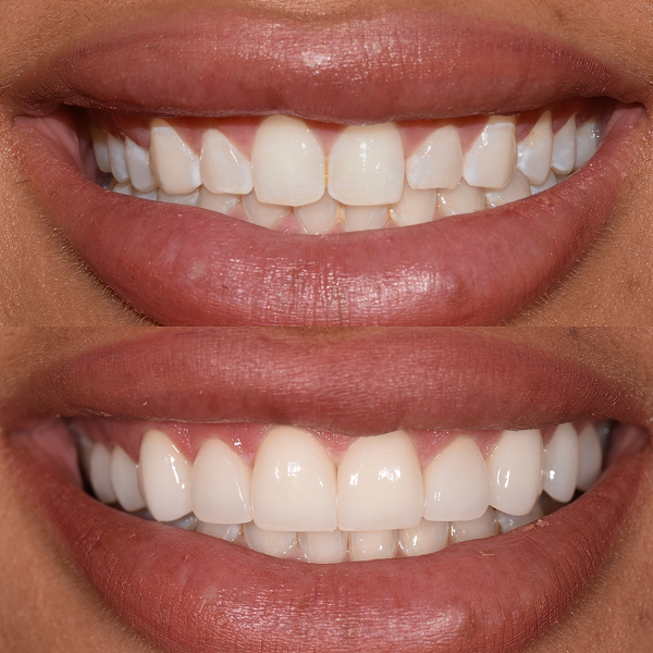 Holland before and after