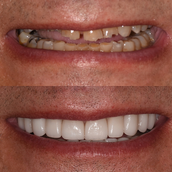Jason before and after