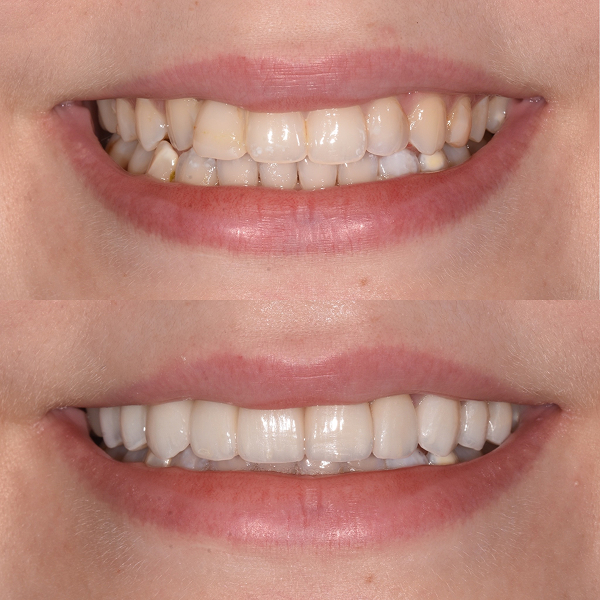 Brittany before and after