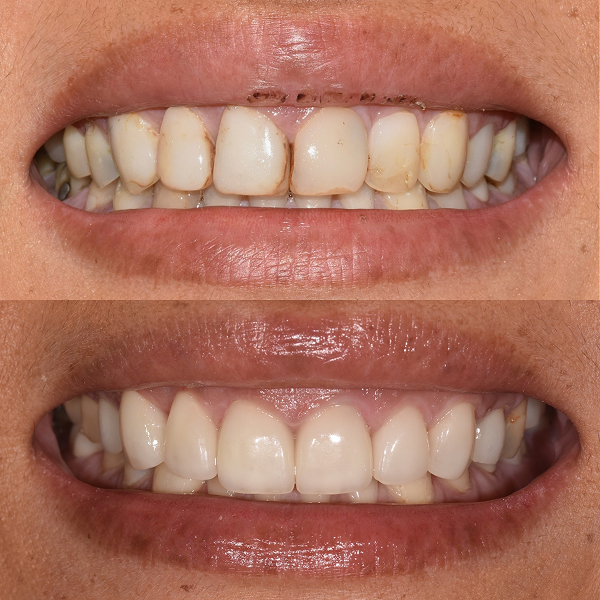 Angie before and after