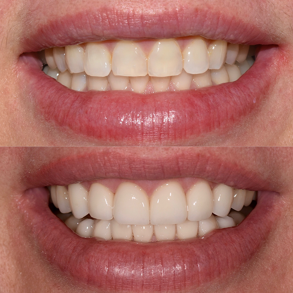 Cindy before and after