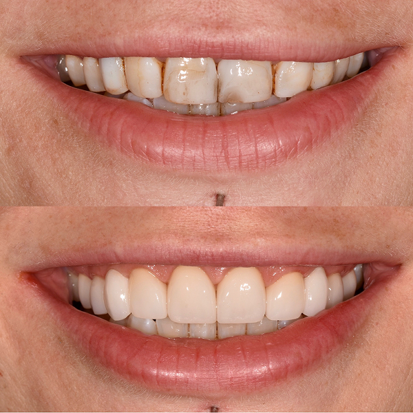 Crystal before and after