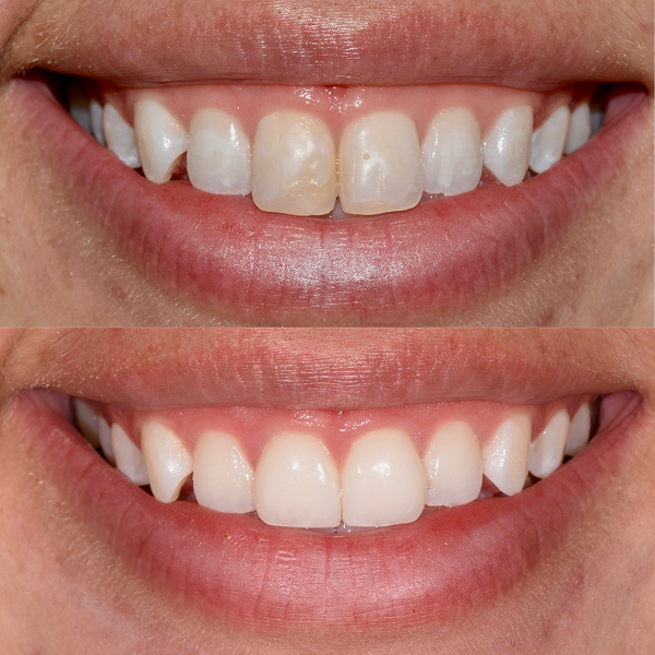 Lindy before and after