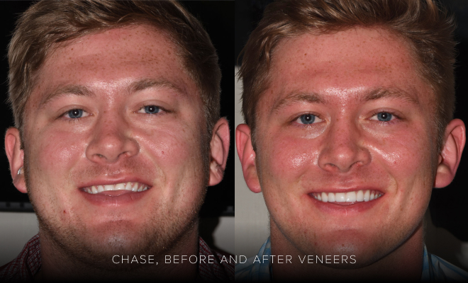 Chase, actual veneers patient before and after