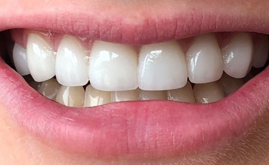 Dr. Clint Newman's patient after veneers