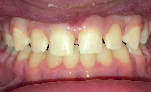 Dr. Clint Newman's patient before veneers