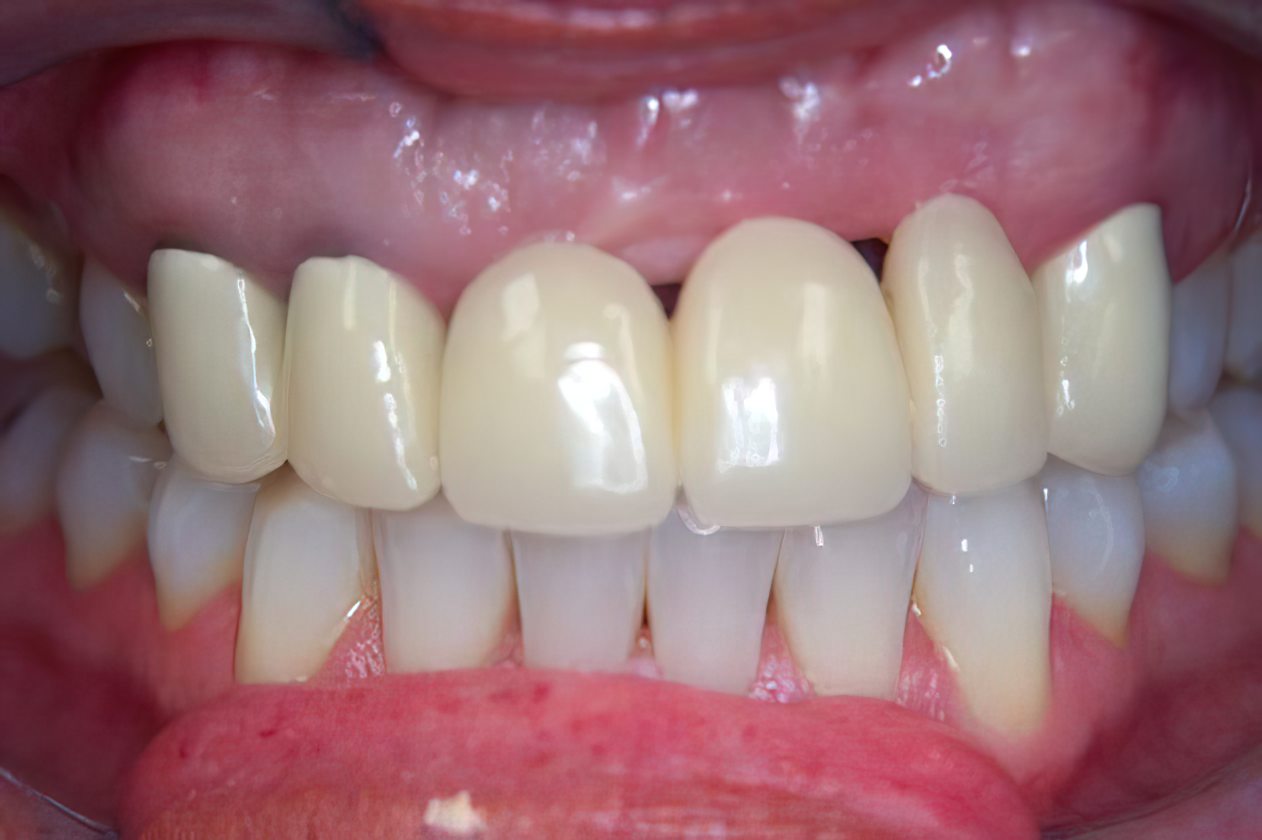 before dental bridge