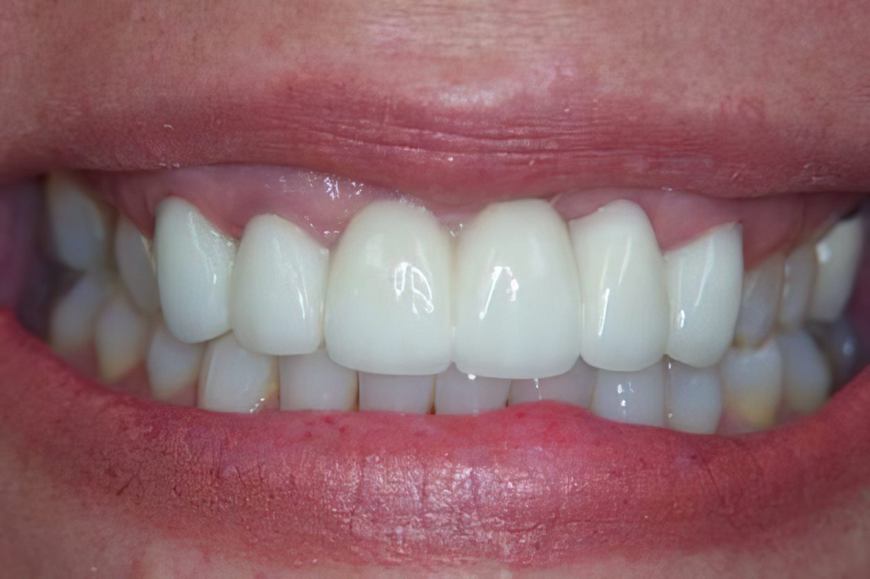 after dental bridge