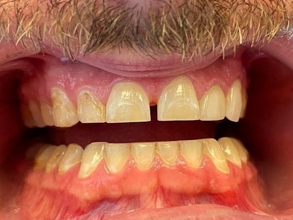Dr. Newman's patient before porcelain dental crowns