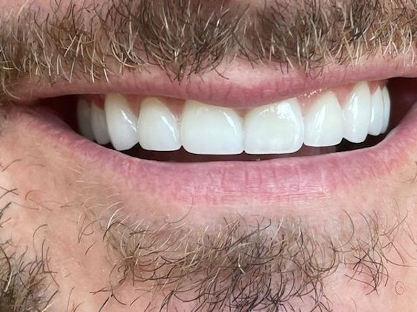 Dr. Newman's patient after porcelain dental crowns