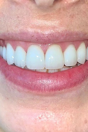 Perfectly even teeth after veneers