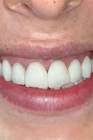 Uneven teeth before veneers