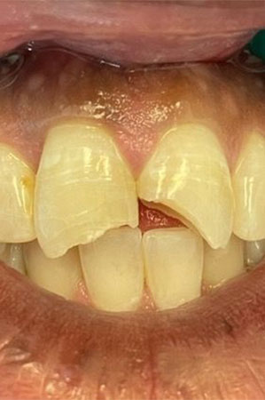 Broken front teeth before crowns