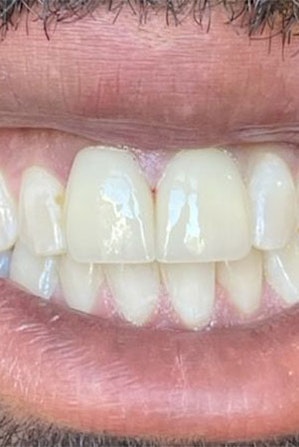 Fixed front teeth that look completely natural after crowns