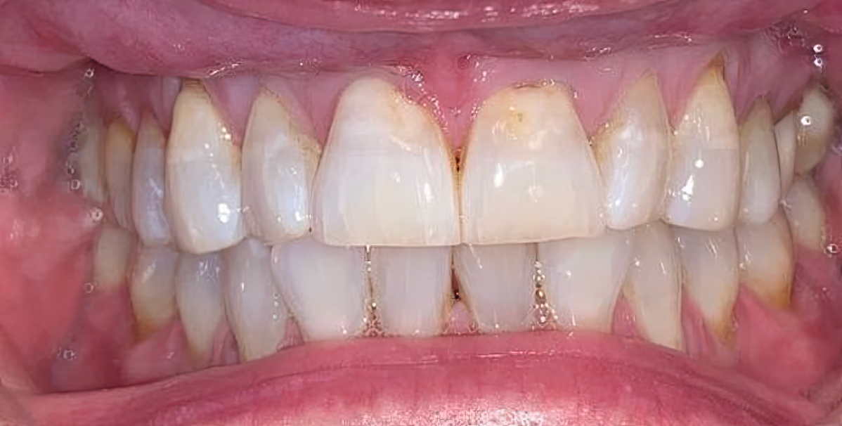 Stained Teeth