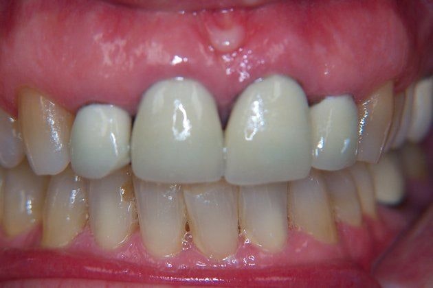 Dr. Newman's patient before dental crowns