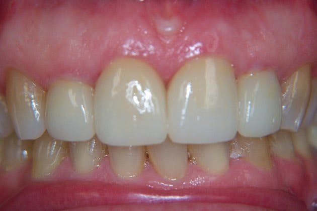 Dr. Newman's patient after dental crowns