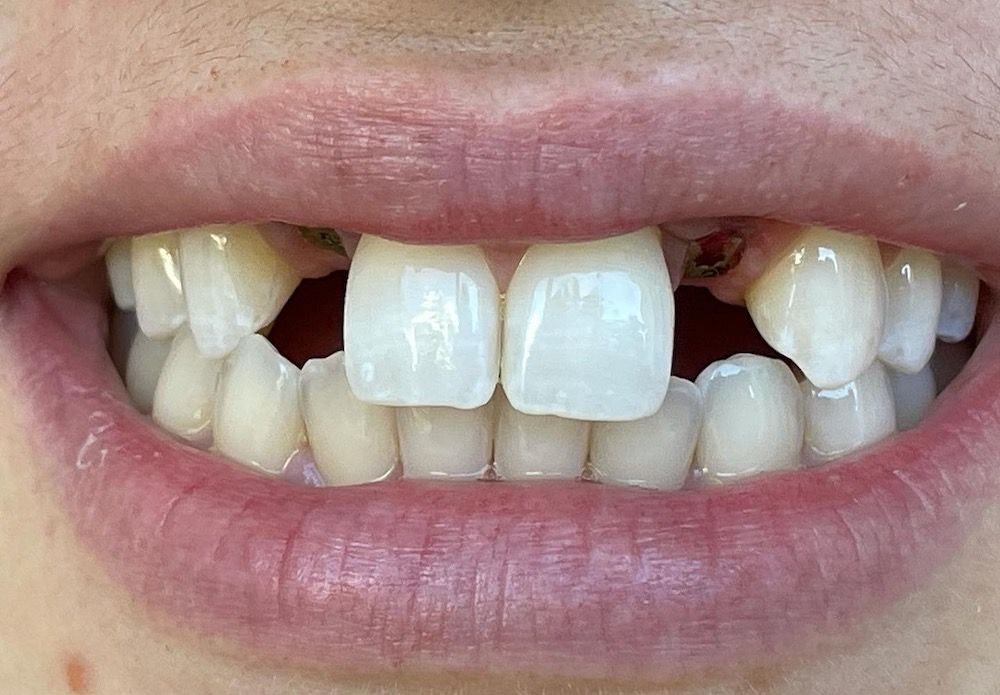 Before Implant-Supported Crowns