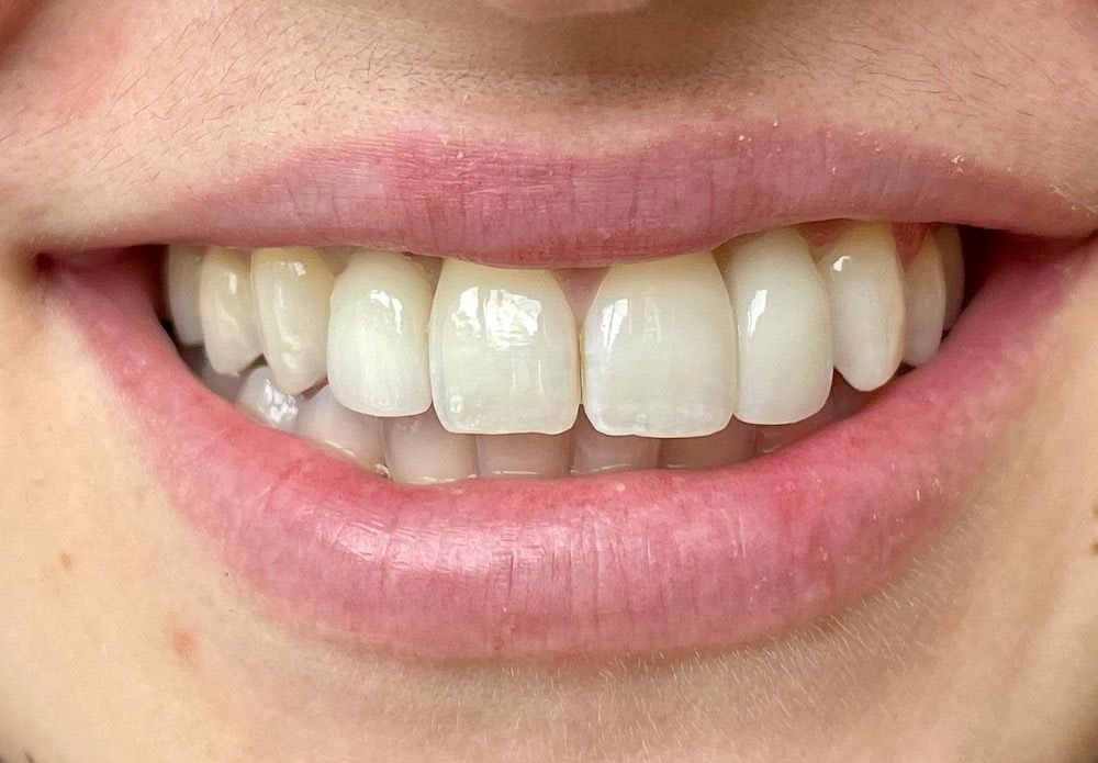 After implant-supported crowns