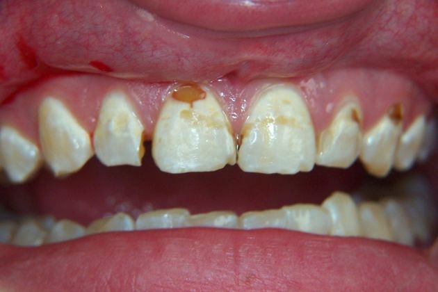Dr. Clint Newman's patient before veneers
