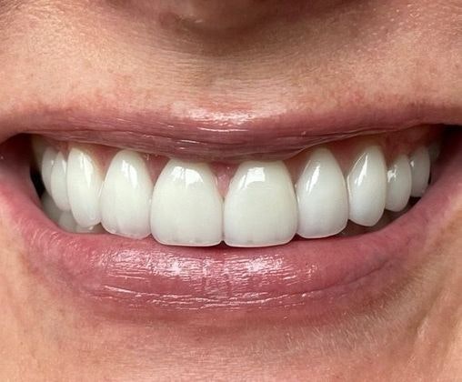 Dr. Clint Newman's patient after veneers