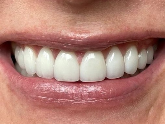 Dr. Clint Newman's patient after veneers