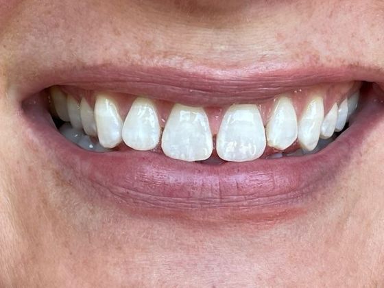 Dr. Clint Newman's patient before porcelain veneers