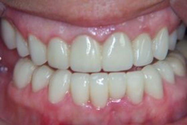 Dr. Clint Newman's patient after full mouth reconstruction